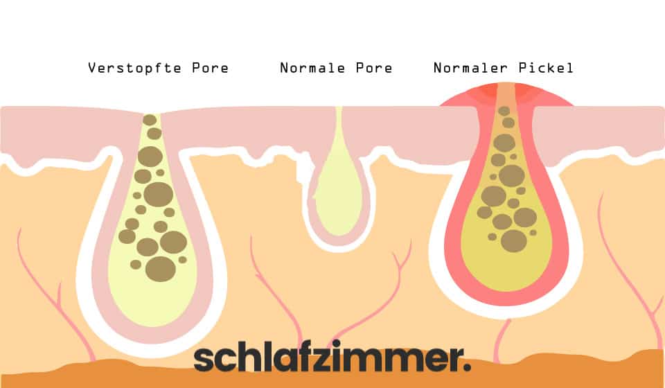 In dieser Grafik erfährst du im Querschnitt wie eine normale Pore oder andere Pickel aussehen
