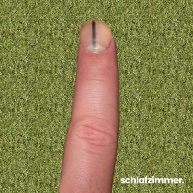 Wunderschne Was Bedeutet Eine Schwarze Linie Auf Dem Fingernagel Ebenbild