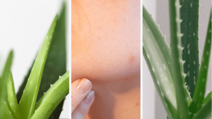 Aloe Vera Gegen Pickel Vorher Nachher Aloe Vera gegen Pickel: 6 Tipps für eine perfekte Anwendung