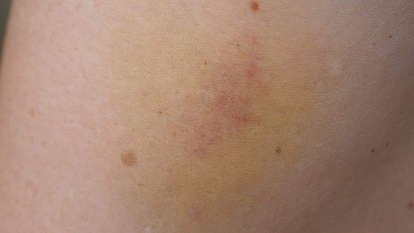 Bluterguss kann durch ältere Haut verstärkt werden